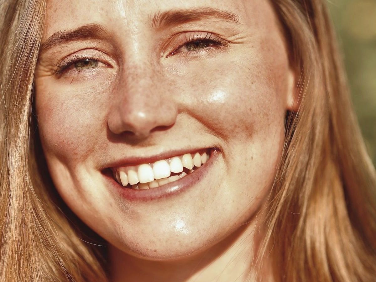 Dasselbe Lächeln mit deutlich helleren Zähnen nach dem Bleaching